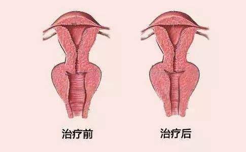 在苏州阴道紧缩手术要多少钱